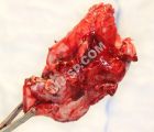 في مدينة #سعود_الطبية.. إنقاذ عشرينية من ورم عدواني يأكل الفك