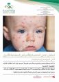 تدشين حملة تطعيم ضد مرض #الحصبة في #شرورة